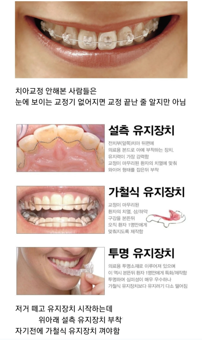 치아교정이 힘든 이유 -치아교정은 평생해야 하는거라 힘들다는데 ㅠㅠ 치아교정하시는 분들 고생 많으시네요ㅠㅠ.png